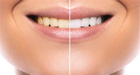Hoe Kom Je Van Gele Tanden Af 3 Effectieve Methodes Om Van Gele Tanden