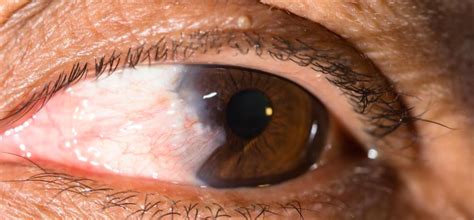 Anterior Segment Eye Diseases Types Causes Symptoms Treatment