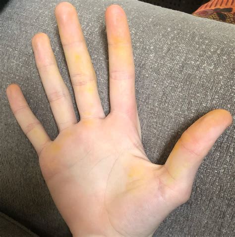 Why Are Both Of My Hands Turning Yellow R Medical