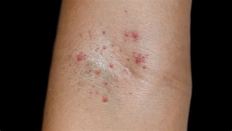 Understanding Petechiae Causes Symptoms And Treatment World Today News