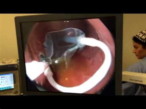 Zavedení jehly je ta nejhorší část. Spatz balon — the spatz adjustable gastric balloon is the ...