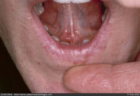 stock image oral medicine submandibular gland swelling large lump under the tongue of a 28 year