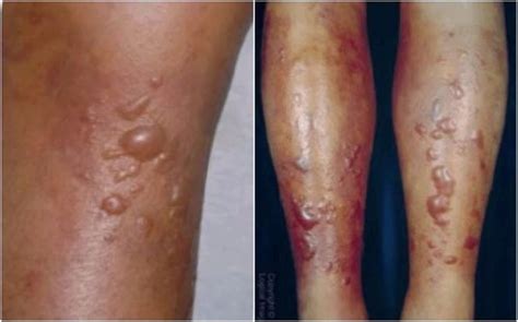 This Is What You Need To Know About A Flesh Eating Bacteria That Took A