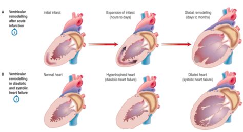 Heart Failure Flashcards Quizlet