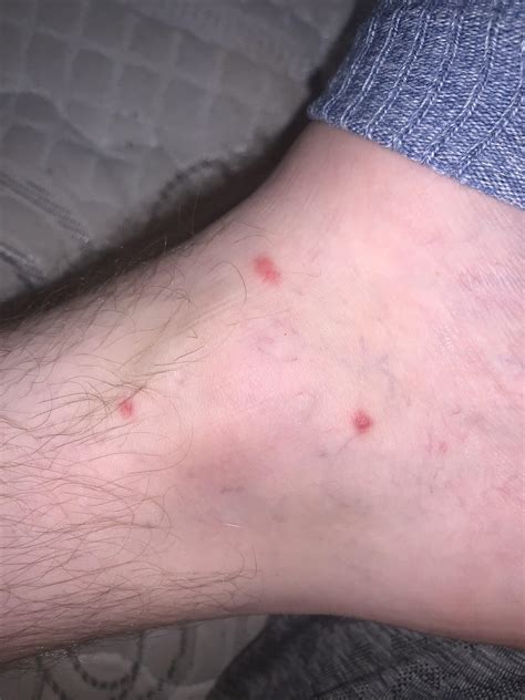 Mild Flea Bites On Humans