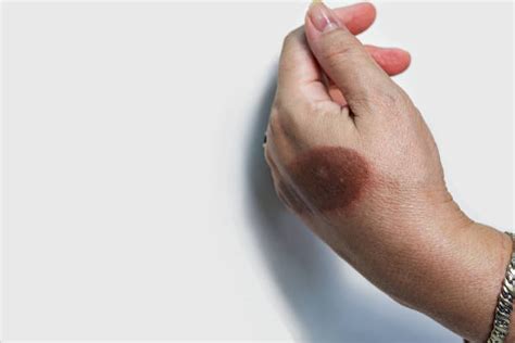 Burnt Hand Stock Photos Pictures And Royalty Free Images Istock