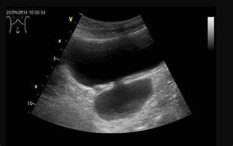 Figure Ultrasound Of A Bladder Diverticulum Statpearls Ncbi
