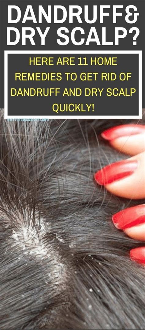 Just as the winter air dries your hands and lips, it also can dry out your scalp. 11 Home Remedies For Dandruff And Dry Scalp | Home ...