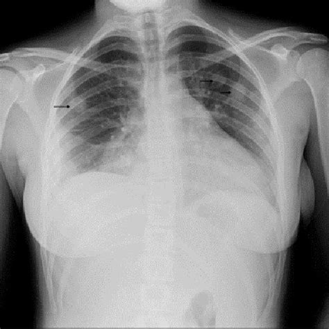 Chest X Ray Revealing Multiple Cavitary Lesions Of Variable Size In