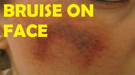 How To Get Rid Of Bruises Fast And Easy On Face Youtube