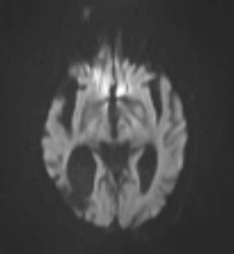Mri Brain A Diffuse Weighted Image Dwi Inferior Slice Showing No