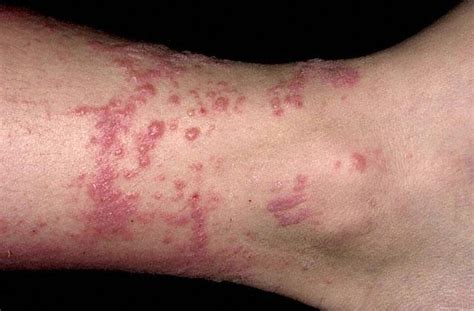 Poison Oak Rash Pictures Causes Symptoms Treatment Contagious