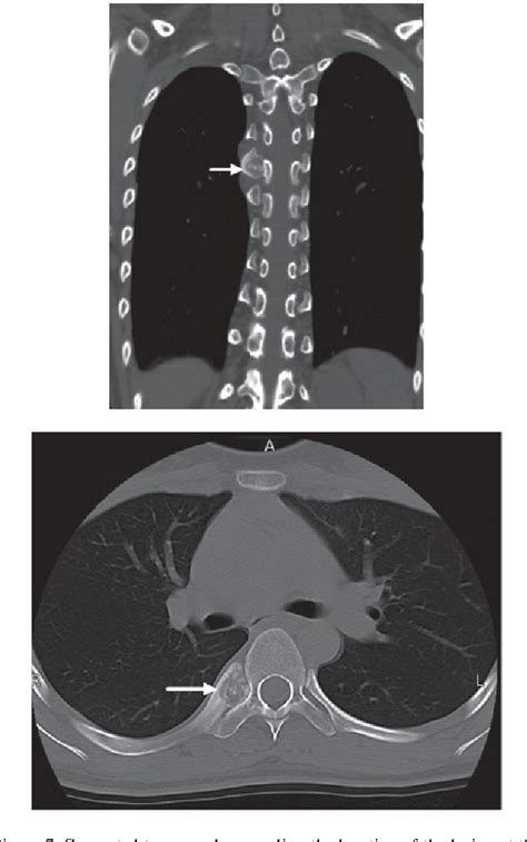 Figure 1 From Osteoid Osteoma Of The Rib A Report Of Two Cases