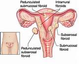 Pictures of Can You Shrink Fibroid Tumors