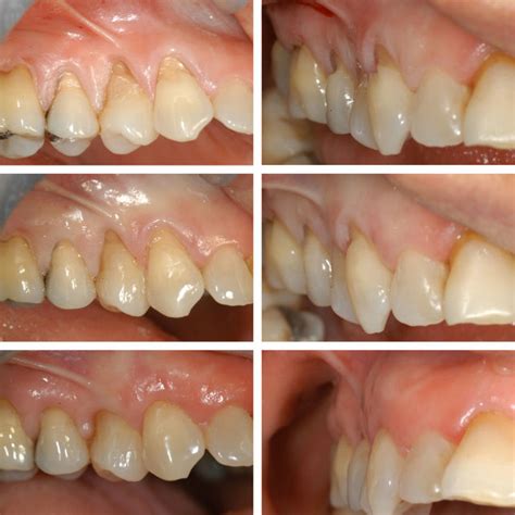 Pdf Surgical Treatment Options For Grafting Areas Of Gingival