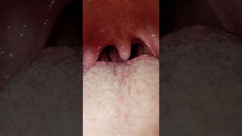 What Does The Back Of Your Throat Look Like