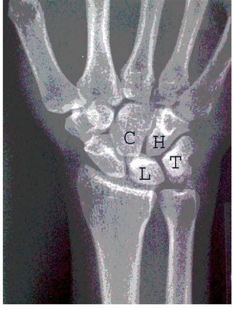 Plain Postero Anterior Radiograph Of The Wrist Showing A Type Ii