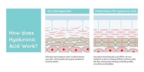 Overall, hyaluronic acid is great for sitting on top of your skin and preventing the moisture from being lost to the outside environment—but it's not foolproof, so use it wisely. Skinboosters - All you need to know | Mizu Aesthetic ...