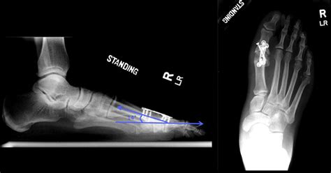 First Metatarsophalangeal Joint Arthrodesis Does The Addition Of A Lag