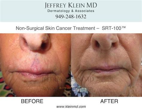 Srt 100 Non Surgical Skin Cancer Treatment Before And After Photos San