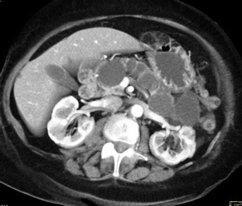 Multiple Pancreatic Cysts Pancreas Case Studies Ctisus Ct Scanning