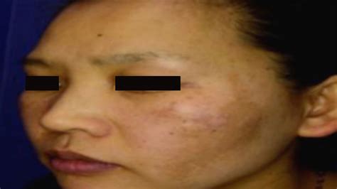 How Can Melasma Laser Treatments For The Upper Lip In Wailea Help