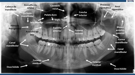 Anatomia Radiográfica Panorâmica Radiologia Odontológica