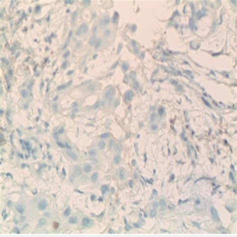 Ascitic Fluid Cytology Finding Consistent With Adenocarcinoma Shown By