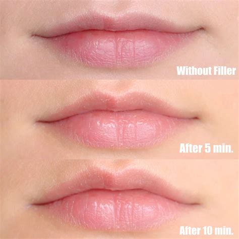 Hyaluronic acid bonds to other hyaluronic acid and water. DermoFuture Hyaluronic Lip Filler Review/Demo | Beauty ...