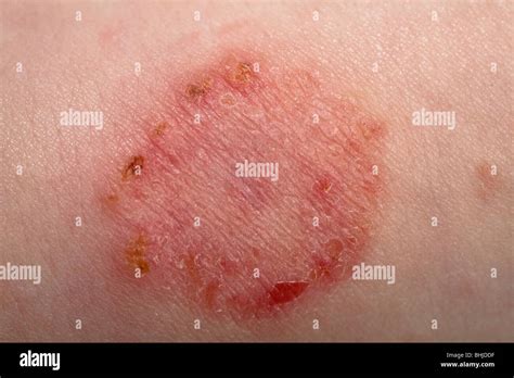 Early Ringworm In Humans