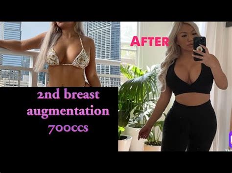 Second Breast Augmentation With CG Cosmetics 700ccs On Petite Woman