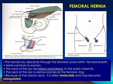Femoral Hernia Female Images