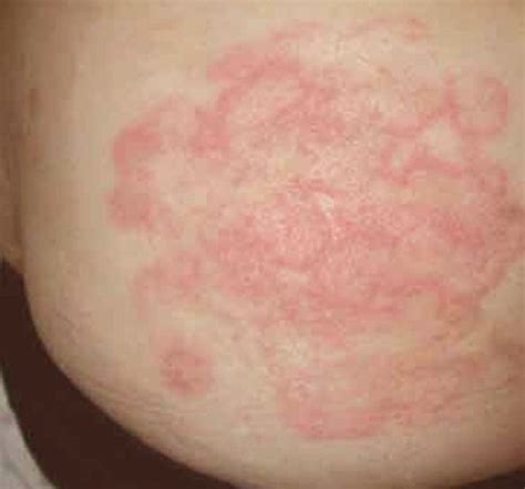 Tinea Corporis Pictures Treatment Causes Symptoms Hubpages