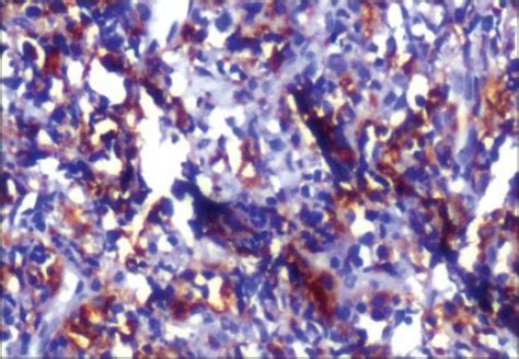 Positive Staining With Immunohistochemical Marker Cd68 Ihc Stain ×400