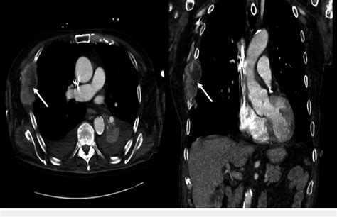 Computed Tomography Of The Chest With Lytic Lesion On Right Ribs