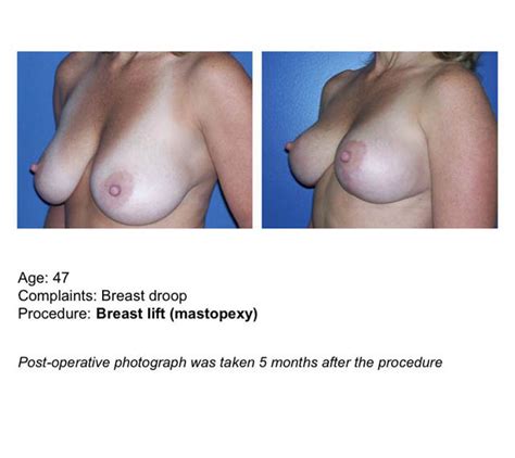 Mastopexy Breast Lift UF Health Plastic Surgery And Aesthetics