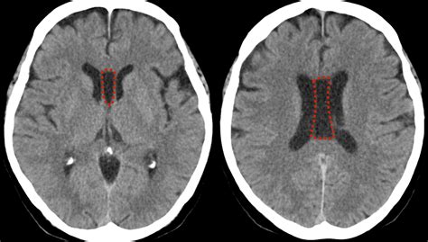 Cavum Septum Pellucidum Cavum Vergae And Cavum Veli Interpositi