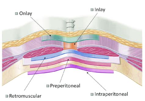 eurahs terminology of mesh positions during ventral hernia repair download scientific diagram