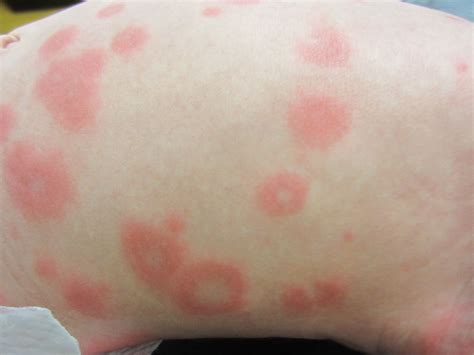 Urticaria Multiforme