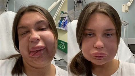 La Joven Tiktoker Que Tuvo Alergia Tras Realizarse Un Relleno De Labios En Las Redes La