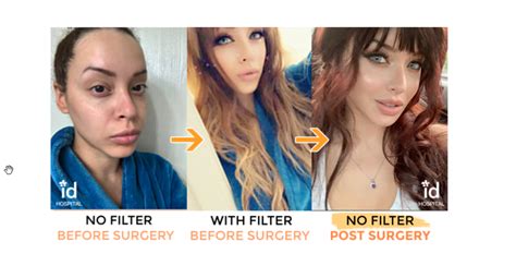 Snapchat Dysmorphia Plastic Surgery At Id Hospital Korea