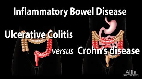 Ulcerative Colitis Versus Crohn S Disease Animation Youtube