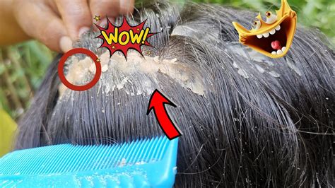 Psoriasis Treatment Dandruff Removal Itchy Scratching Huge Flakes