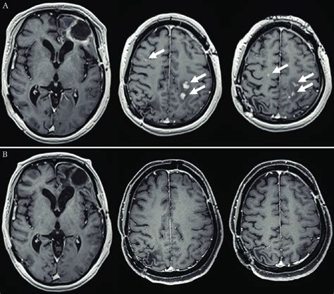 The Left Frontal Tumor Responded To Intensity Modulated Radiotherapy