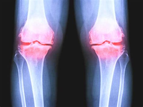 Osteoarthritis Of The Knee X Ray