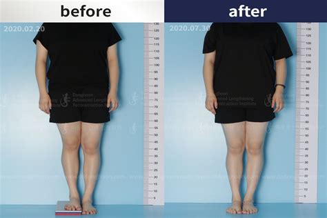Leg Lengthening Surgery Leg Length Discrepancy Precice