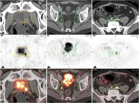 Since prostate cancer is the second highest cause of death in the united states alone, preventing the disease will, hopefully, lower the number of deaths caused by other clinical trials are carried out on men who have had prostate cancer and are trying to prevent recurrence, or to lower their chance of. 68Ga-PSMA-11 PET/CT Mapping of Prostate Cancer Biochemical ...