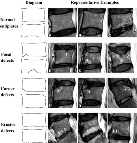 Lumbar Vertebral Endplate Defects On Magnetic Resonance Imag Spine