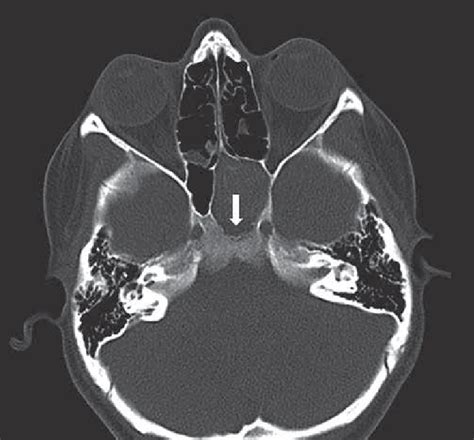 Axial Bone Window Ct Image Shows Expanded Sinus And Focal Areas Of