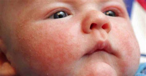 Infantile Seborrheic Dermatitis Face